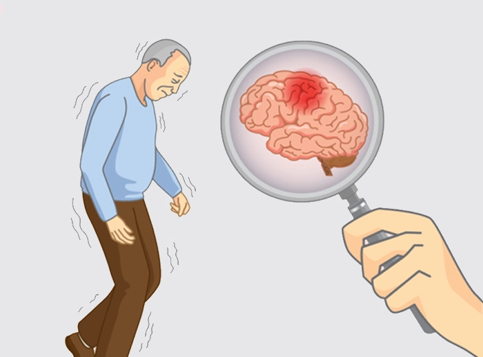 Alzheimer